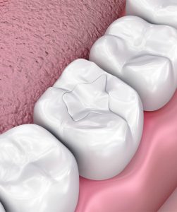sealants