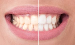 Whiten Teeth