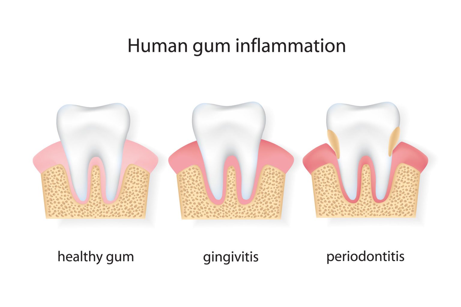 Periodontal Scaling & Root Planing Magnolia Family Dental Care