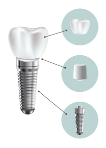 Dental implant structure medical pictorial educative infographic poster