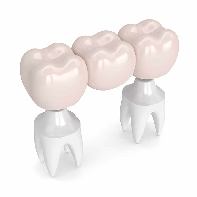 3d render of dental bridge with dental crowns isolated over white background