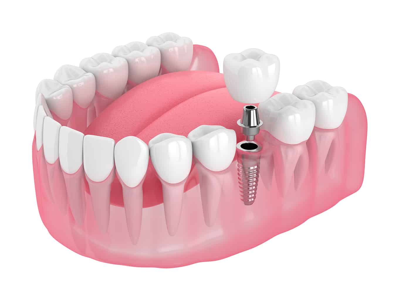 3d render of jaw with dental implant isolated over white background