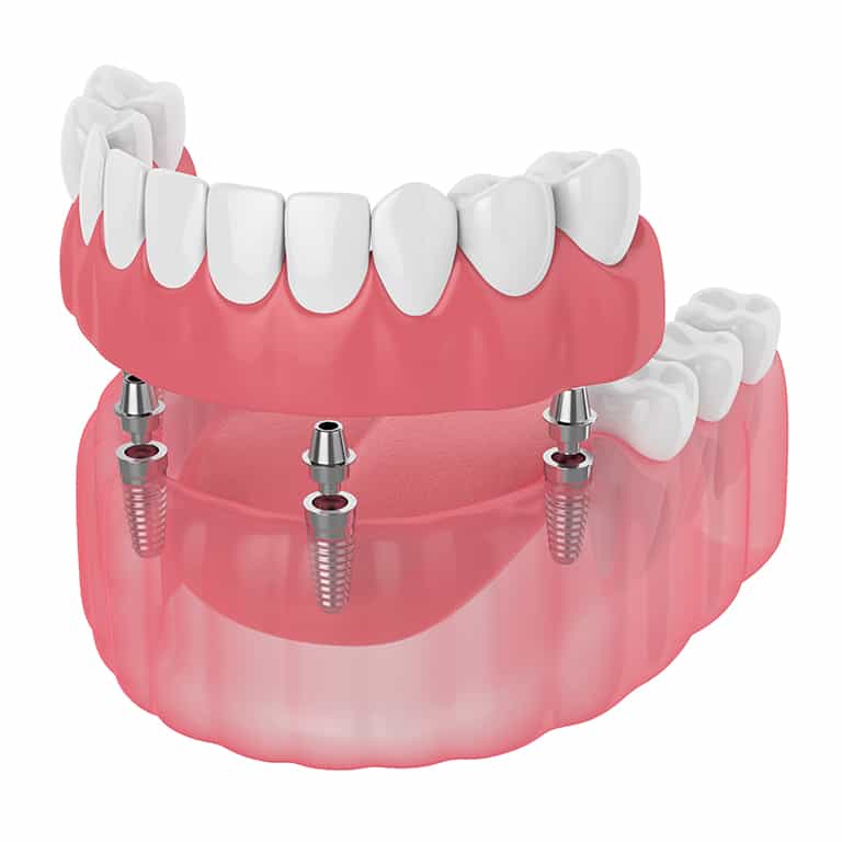 3d render of implant partial denture isolated over white background