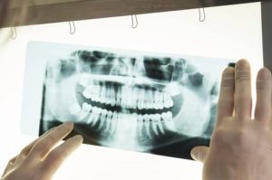 Tulsa dental extractions