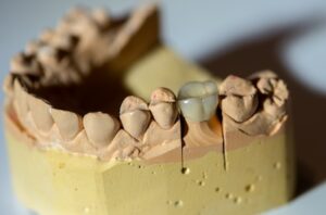 Dental Crown Emergency