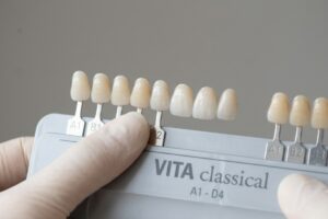 Dental shade guide (VITA classical) held by a hand, showing A1–D4 shade tabs for matching tooth color